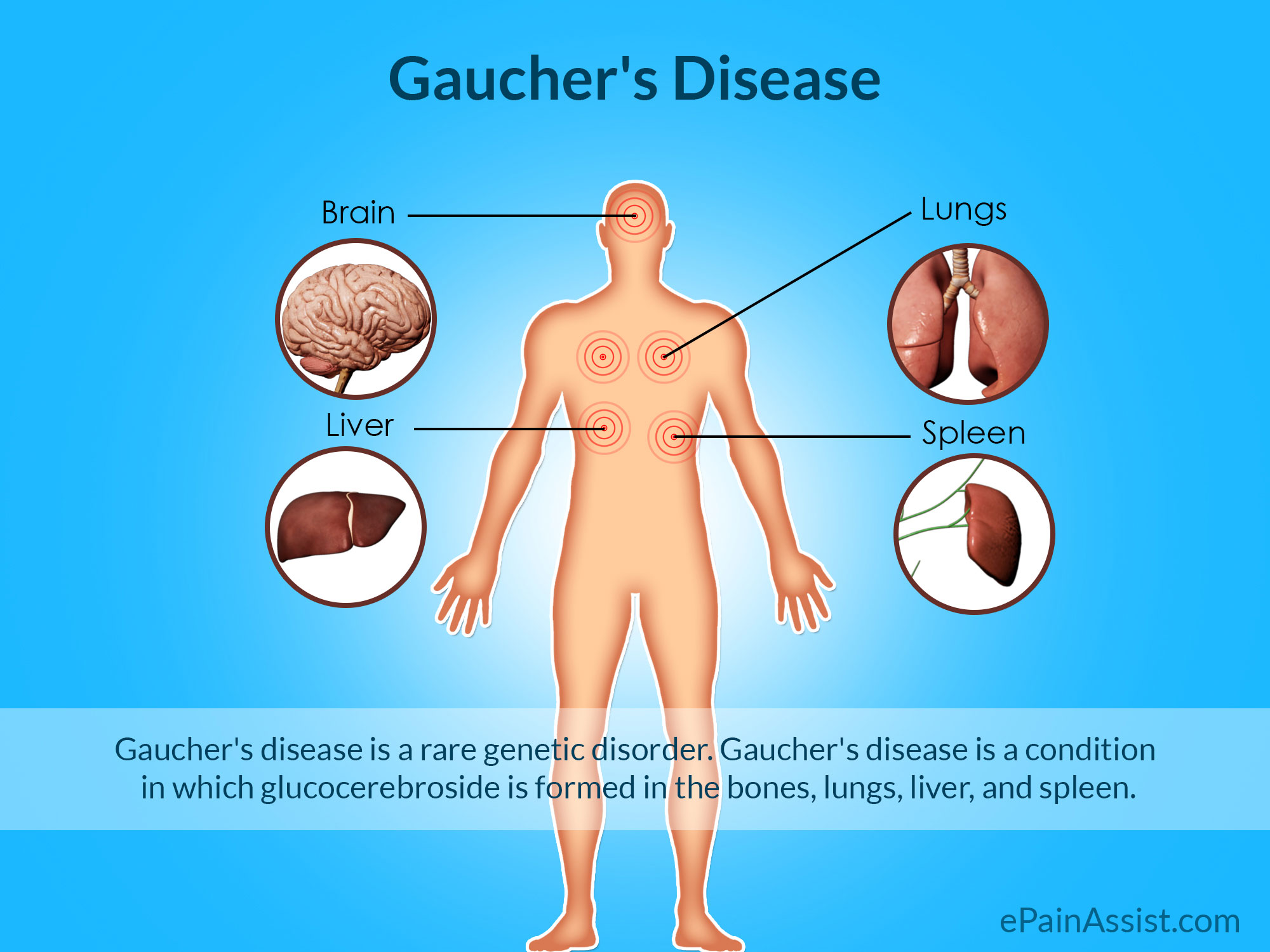 What Type Of Care Do Gaucher Diseased People Need
